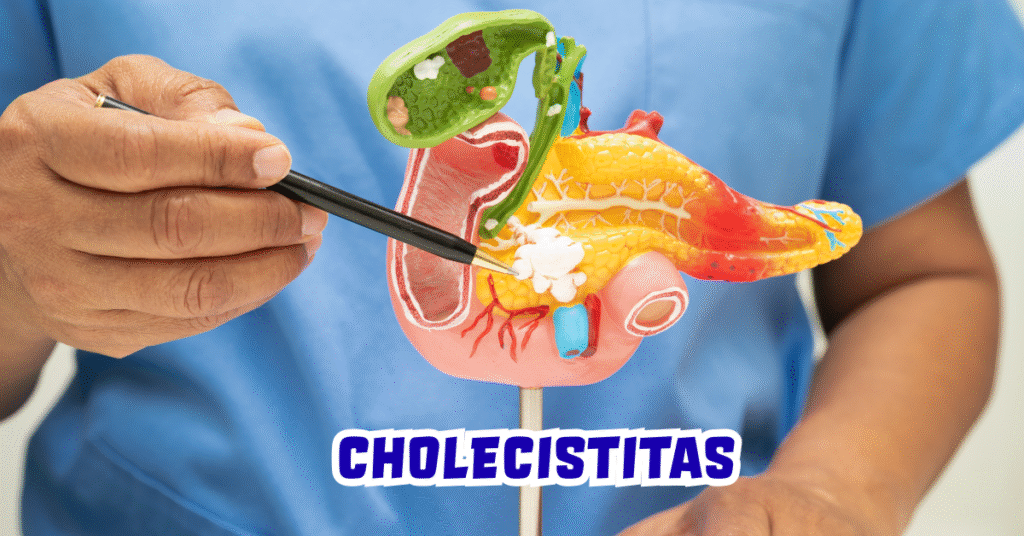 Cholecistitas