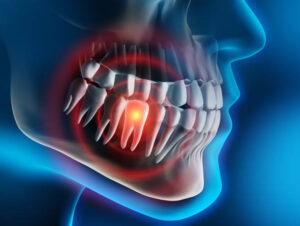 Kill Tooth Pain Nerve in 3 Seconds Permanently