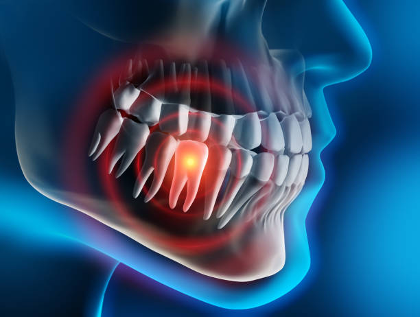 Kill Tooth Pain Nerve in 3 Seconds Permanently
